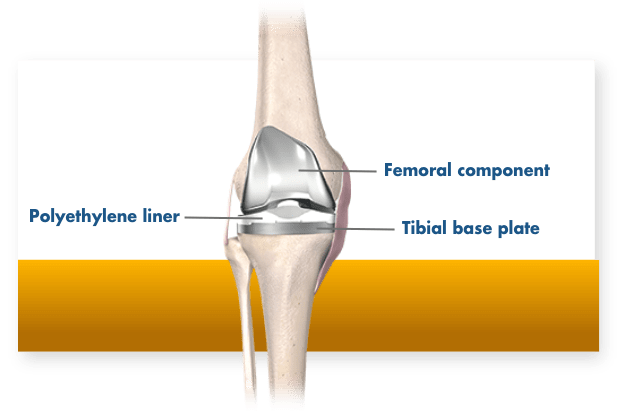 Robotic Knee Replacement Perth